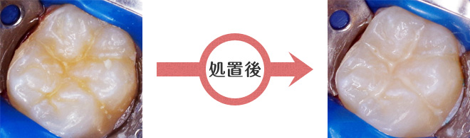 シーラント
