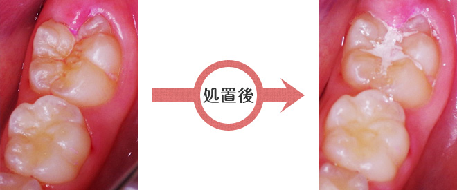 シーラント